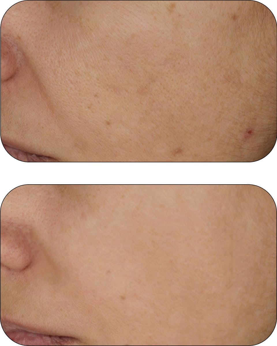 CLINICAL BEAUTY FILLER | 2 MONTH