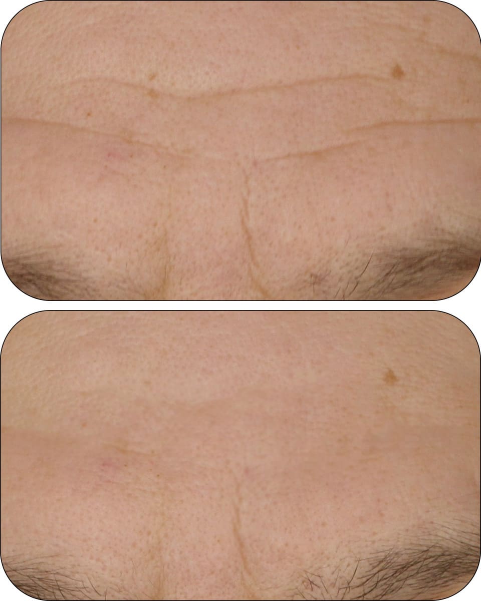CLINICAL BEAUTY FILLER | 2 MONTH